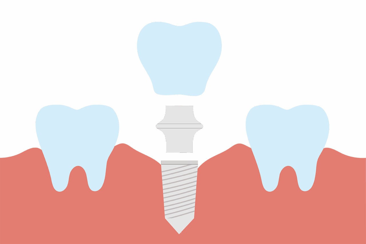 インプラントとは?メリット・デメリットや治療の流れ