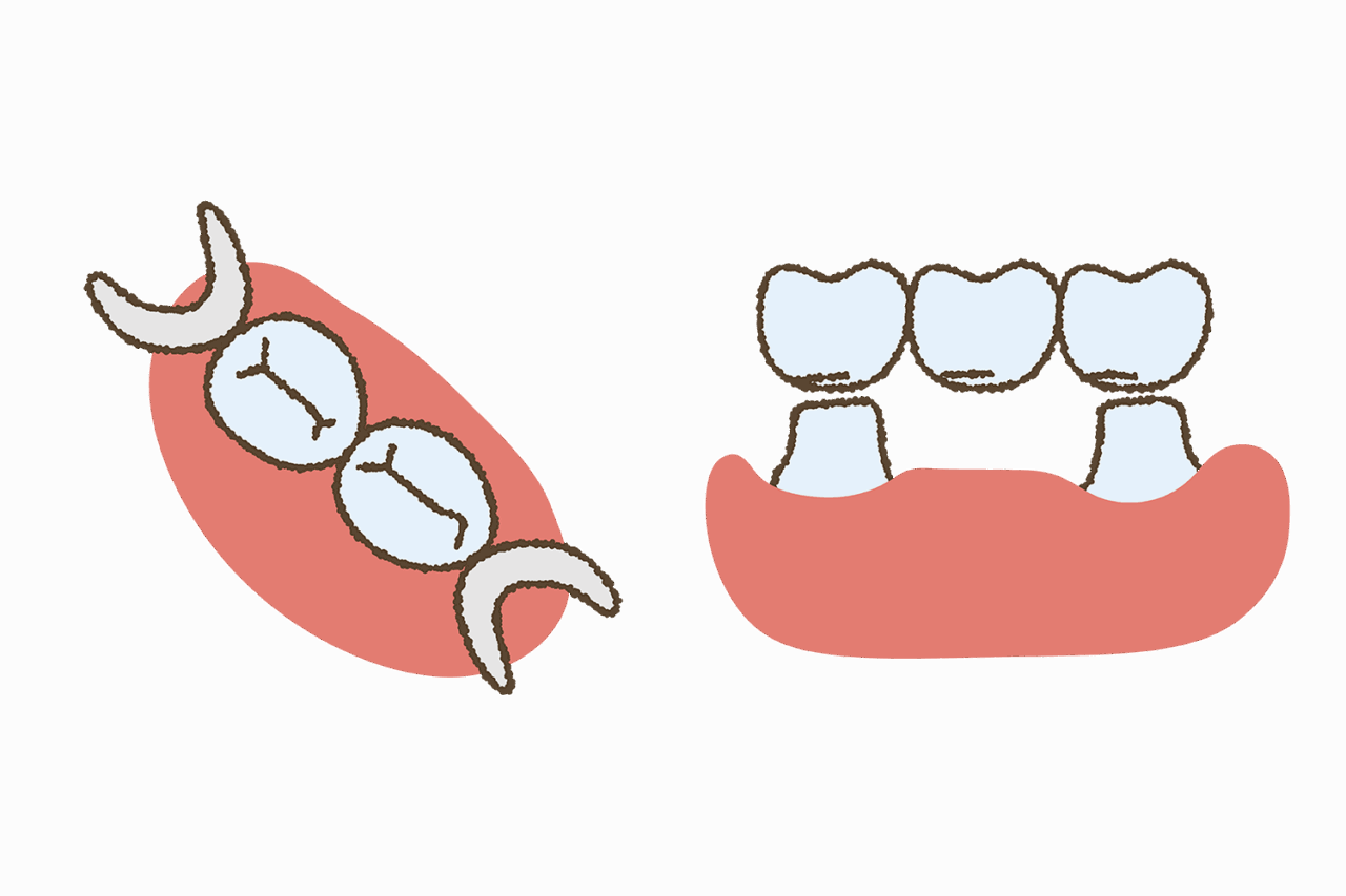 ブリッジや入れ歯との違いは?