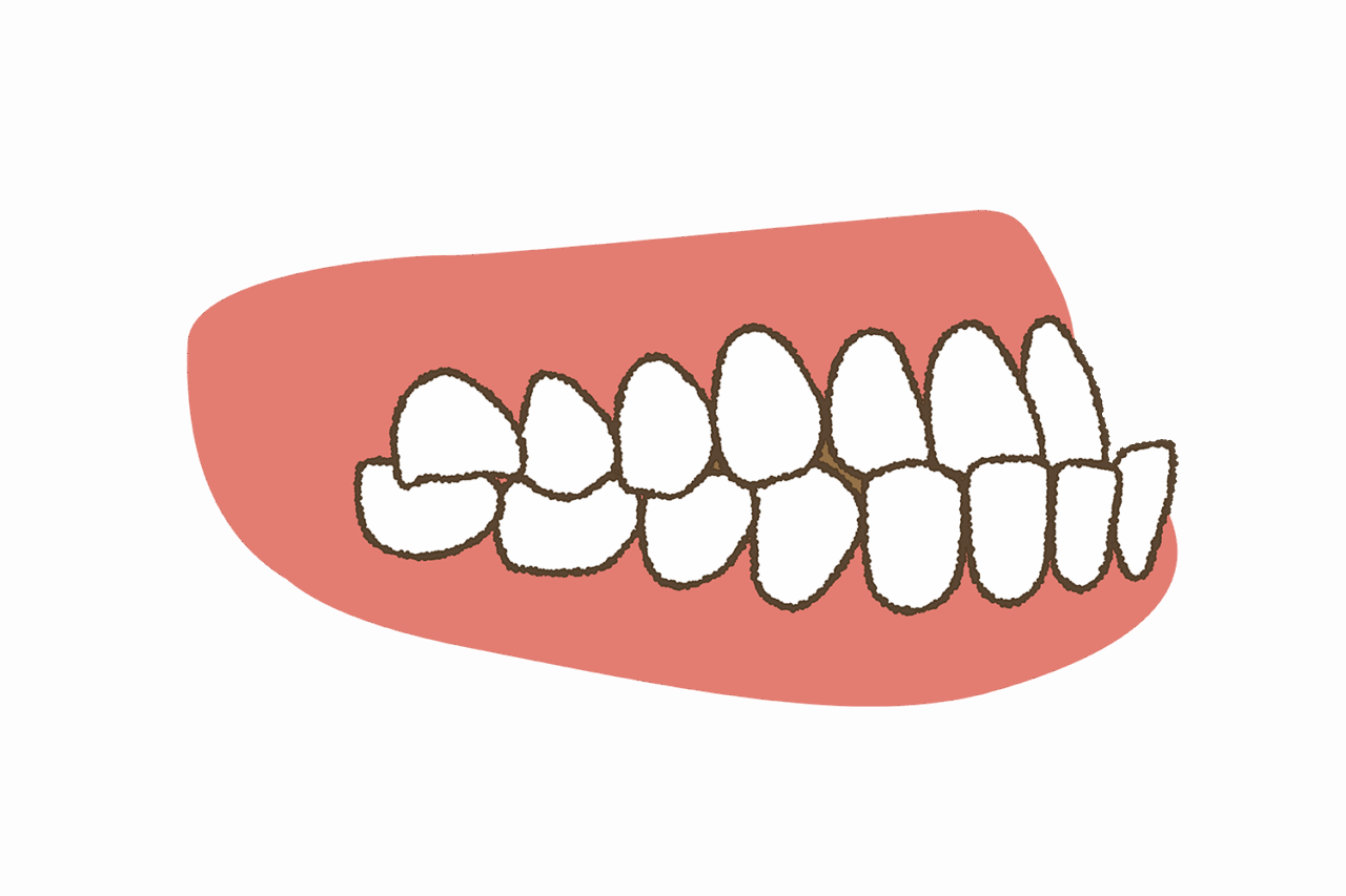 こどもの歯がしゃくれている（受け口）