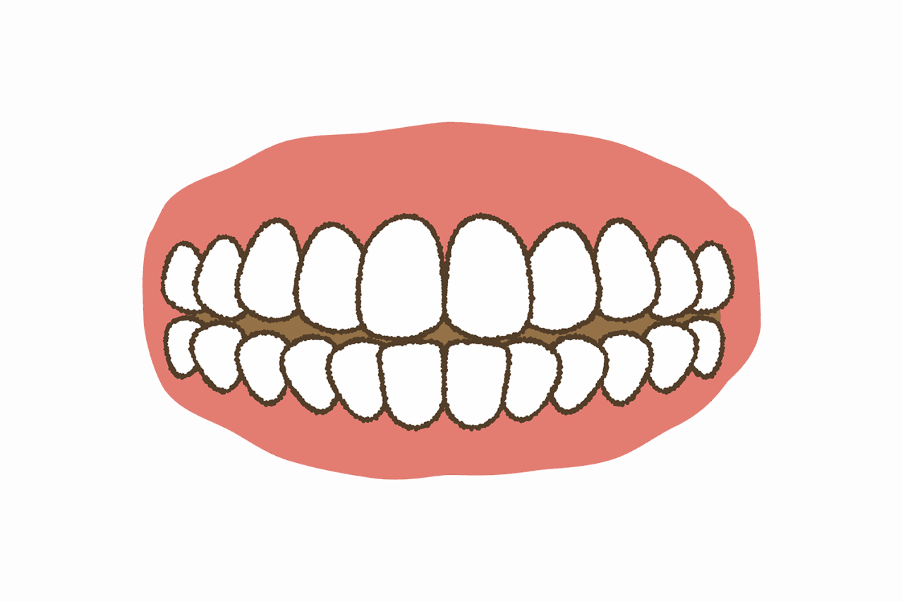 こどもの前歯が噛み合わない