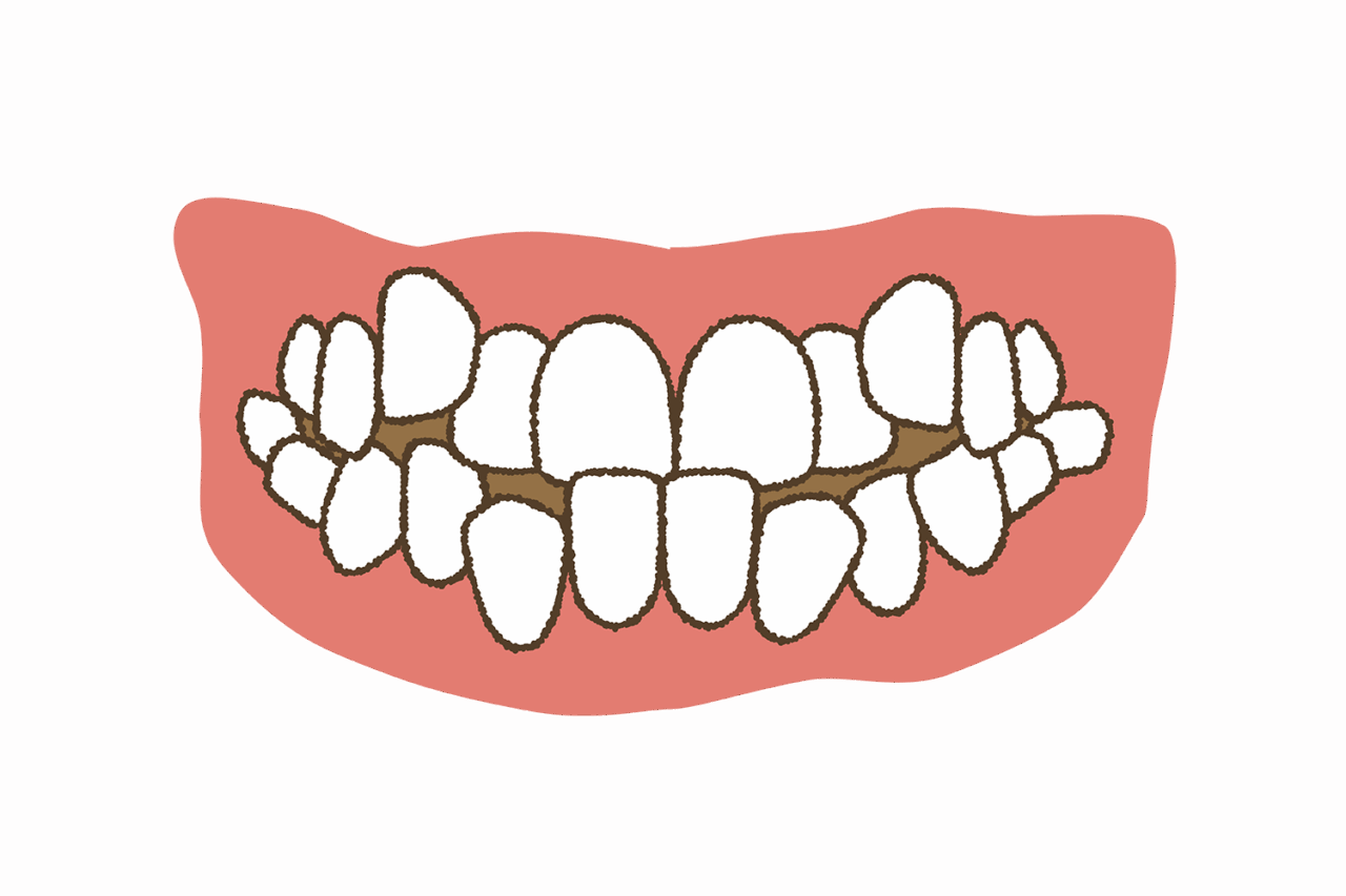 こどもの歯がガタガタ