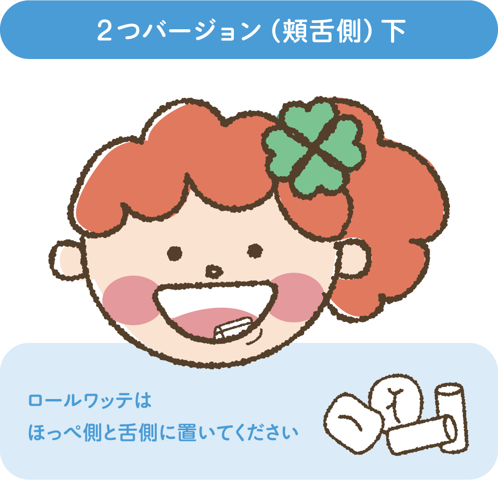 2つバージョン（頬舌側）下