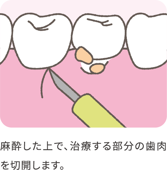 emdogain-01_pc@2x-min