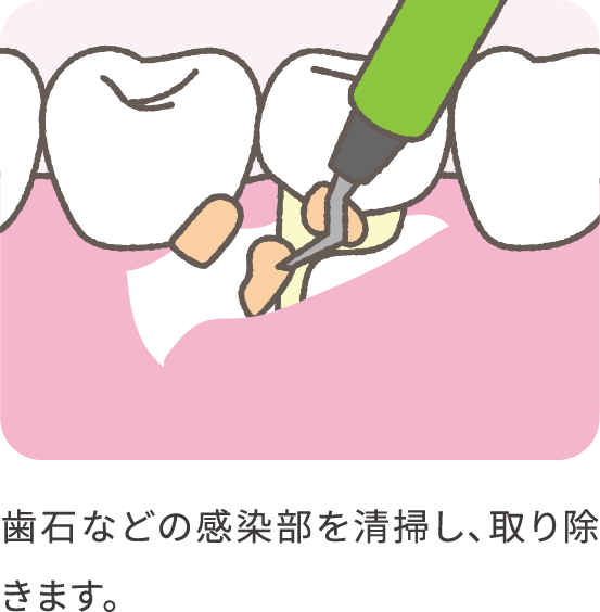 emdogain-02_pc@2x-min