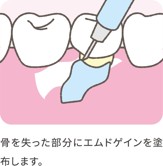 emdogain-03_pc@2x-min