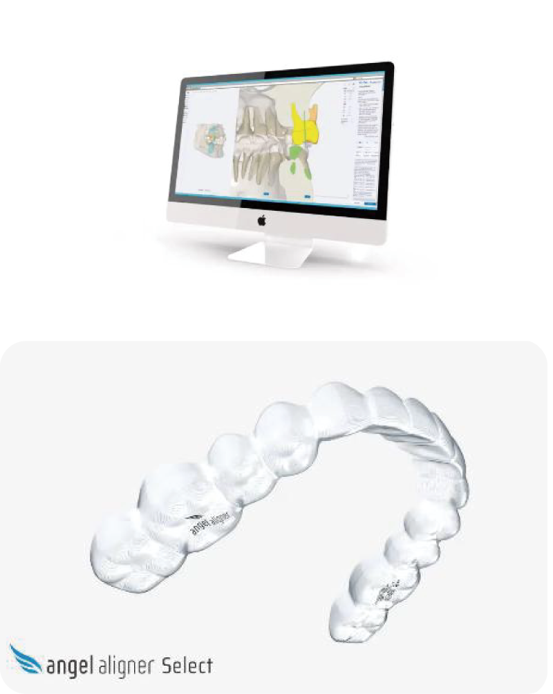 angel alignerイメージ