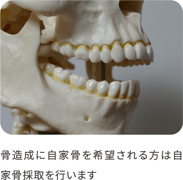 implant-GTR-01_pc@2x-min